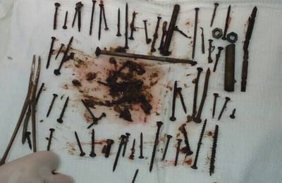 В Бурятии хирурги достали из желудка пенсионерки более 150 гаек и болтов