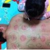 Плевать, если я заболею, я сам себе поставить банки сумею