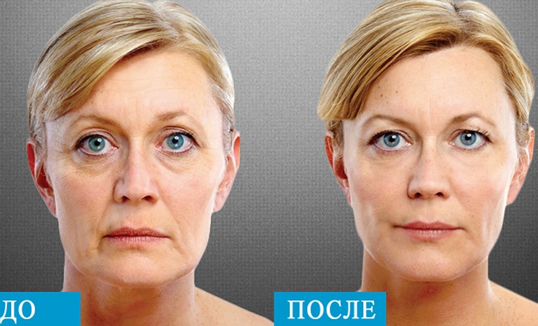 Результат процедуры СМАСлифтинга на аппарате Альтера