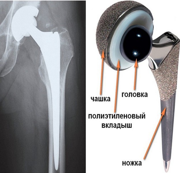 Нанокерамический протез